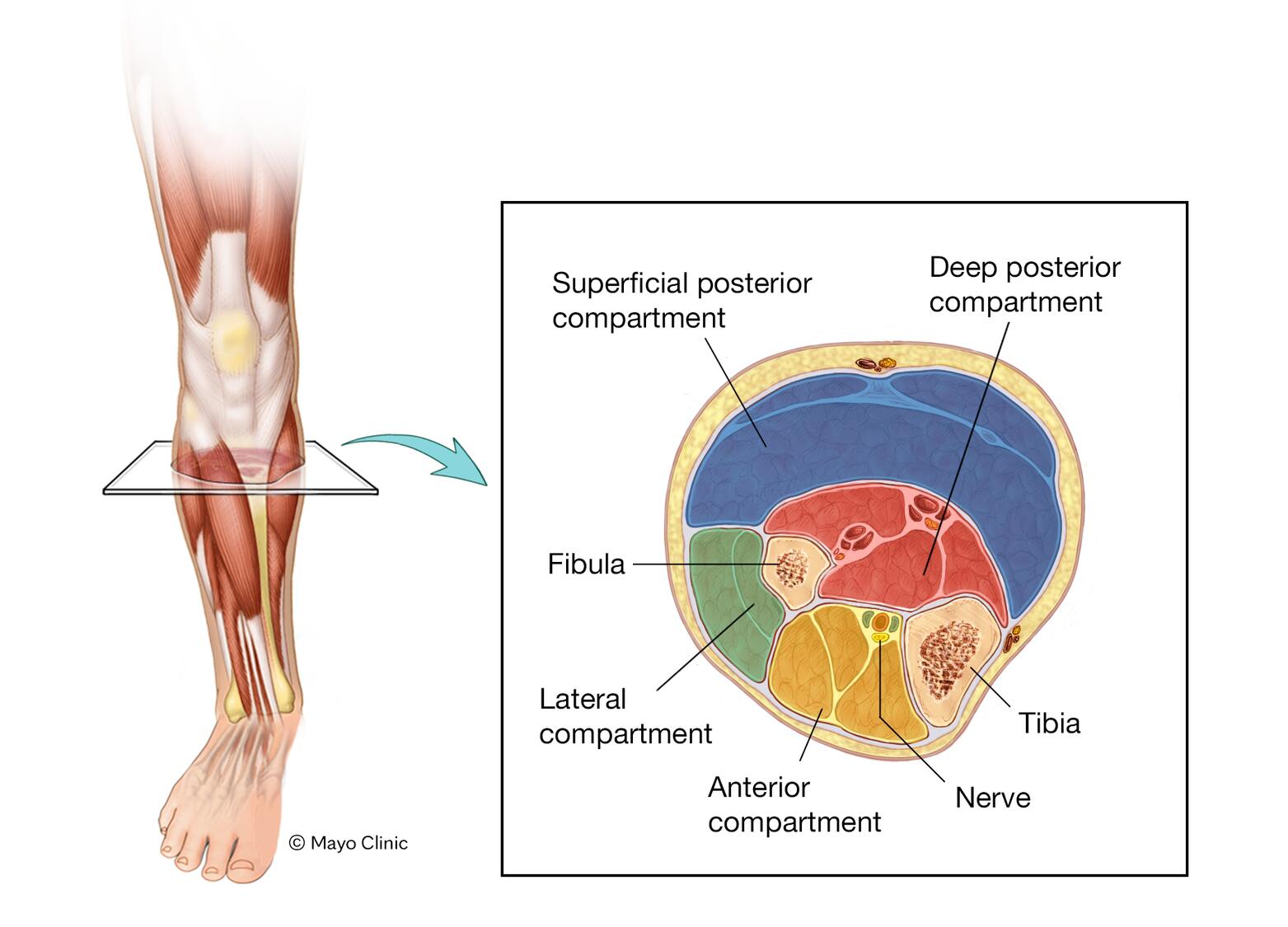 Chronic exertional compartment syndrome - Symptoms & causes - Mayo