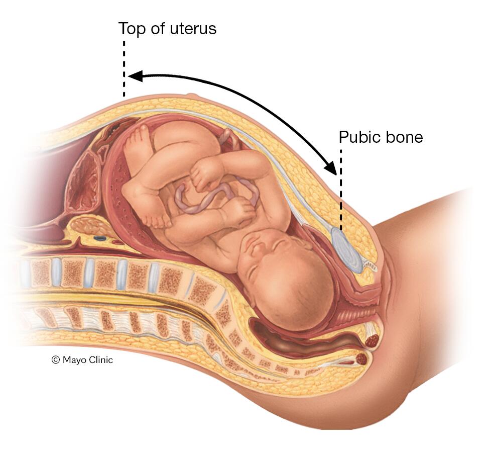 Fetal macrosomia - Symptoms & causes - Mayo Clinic