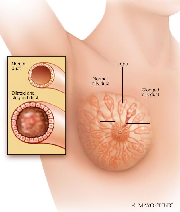 Breast Masses (Breast Lumps) - Gynecology and Obstetrics - Merck