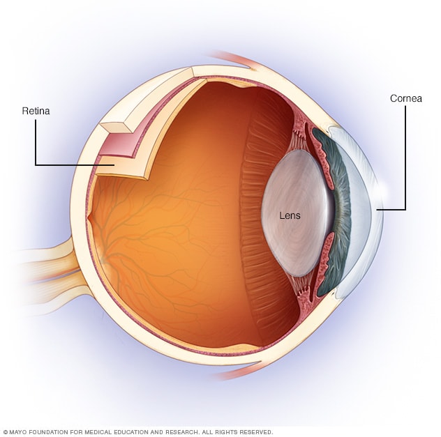 Astigmatism Eye Shape