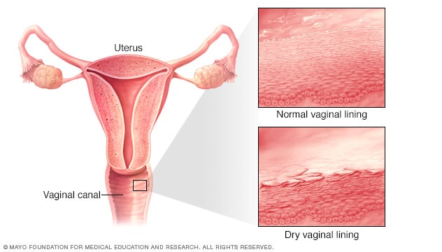 What Is Vaginal Dryness? Symptoms, Causes, Diagnosis, Treatment