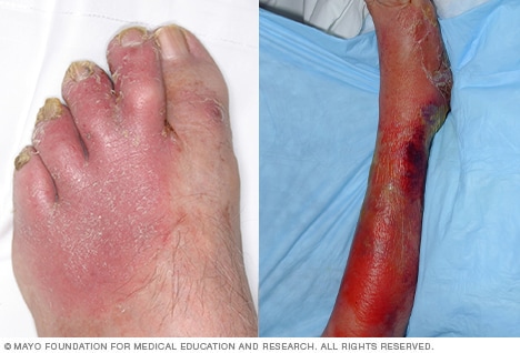 Hand-foot-and-mouth disease - Symptoms & causes - Mayo Clinic