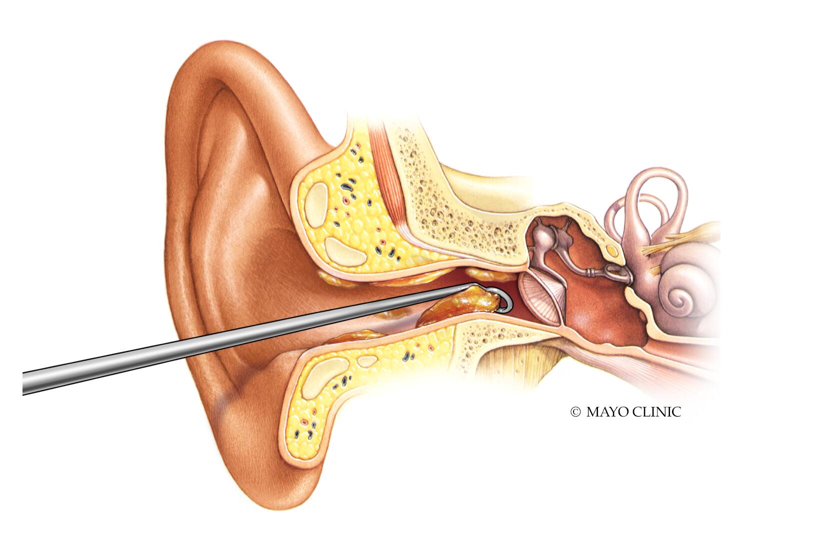 Earwax blockage - Diagnosis & treatment - Mayo Clinic