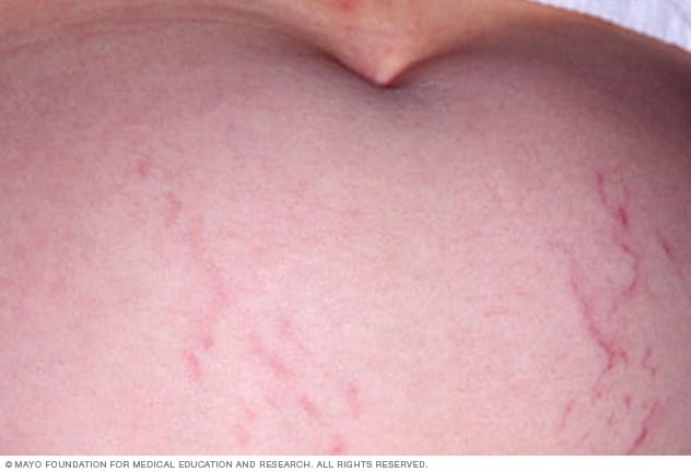 Stretch marks - Symptoms & causes - Mayo Clinic