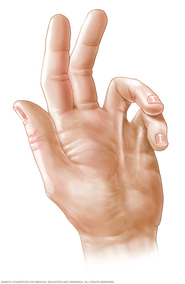 Photograph of a hand with Dupuytren's contracture