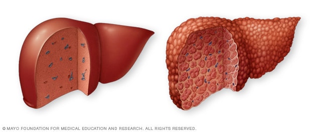Illustrations of a normal liver and liver cirrhosis