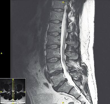 Minimally invasive spinal surgery - For Medical Professionals - Mayo Clinic